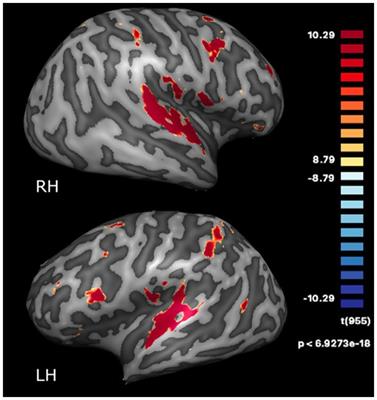 Neural effects of multisensory dance training in Parkinson’s disease: evidence from a longitudinal neuroimaging single case study